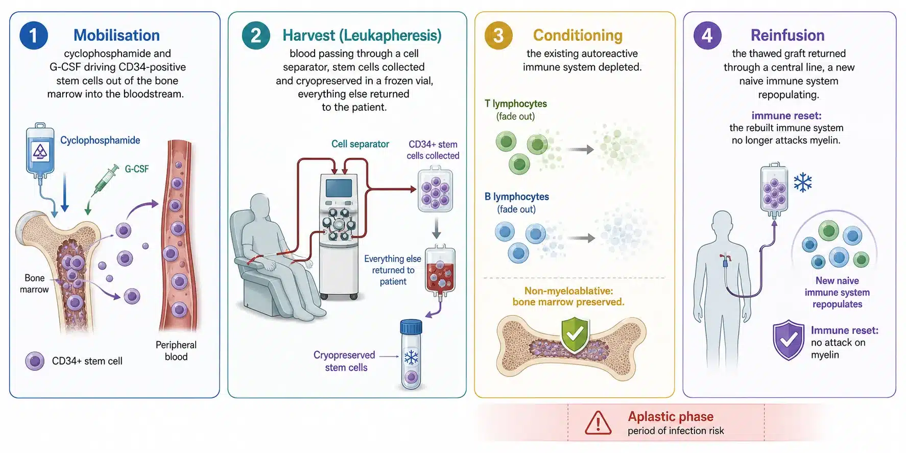 The four stages of HSCT for multiple sclerosis: stem cell mobilisation, harvesting, conditioning chemotherapy and reinfusion.