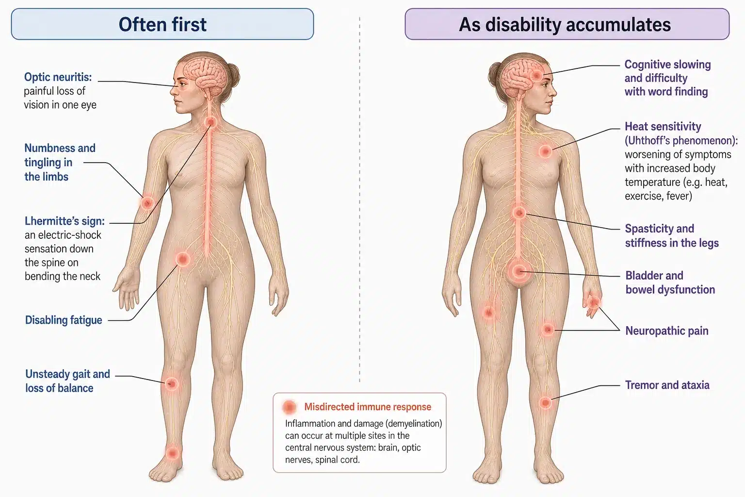 The symptoms of multiple sclerosis, from optic neuritis and numbness at first presentation to spasticity, bladder dysfunction and cognitive slowing as disability accumulates.