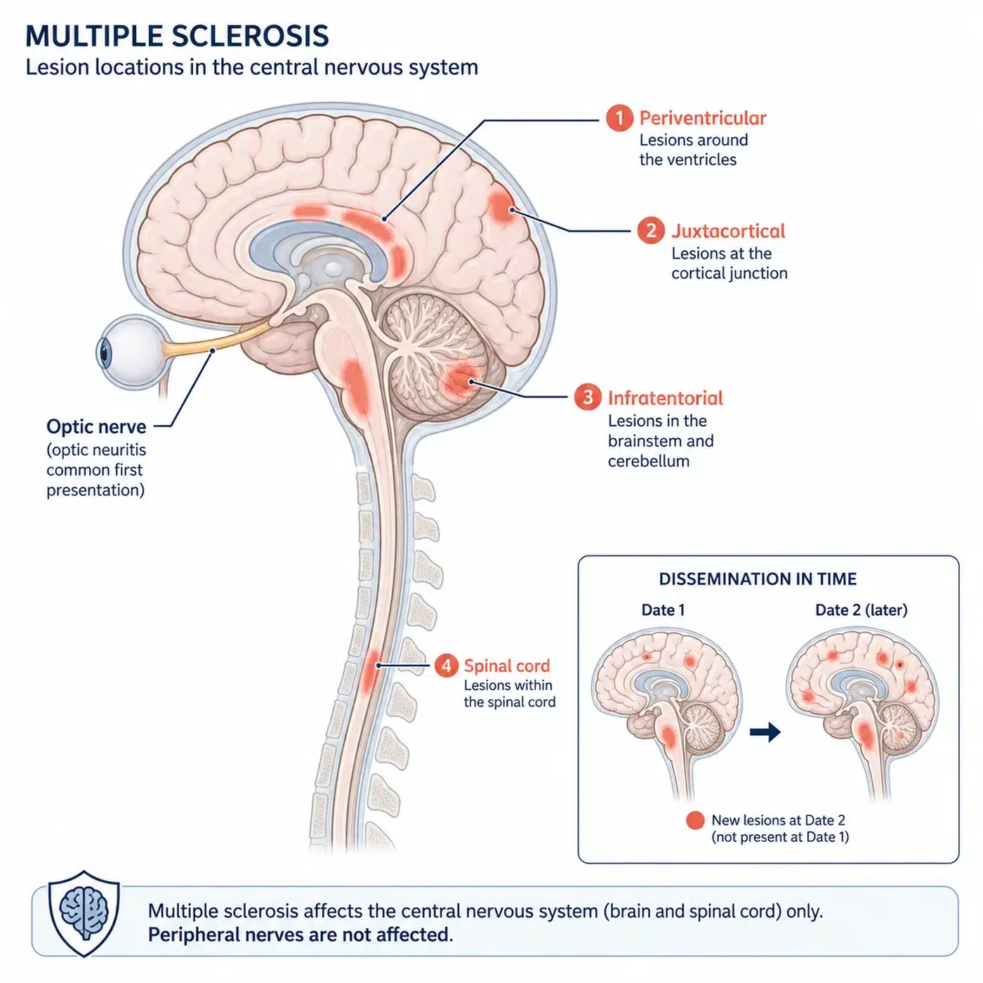 Where multiple sclerosis lesions form in the brain, spinal cord and optic nerve, the four classic sites used in diagnosis.