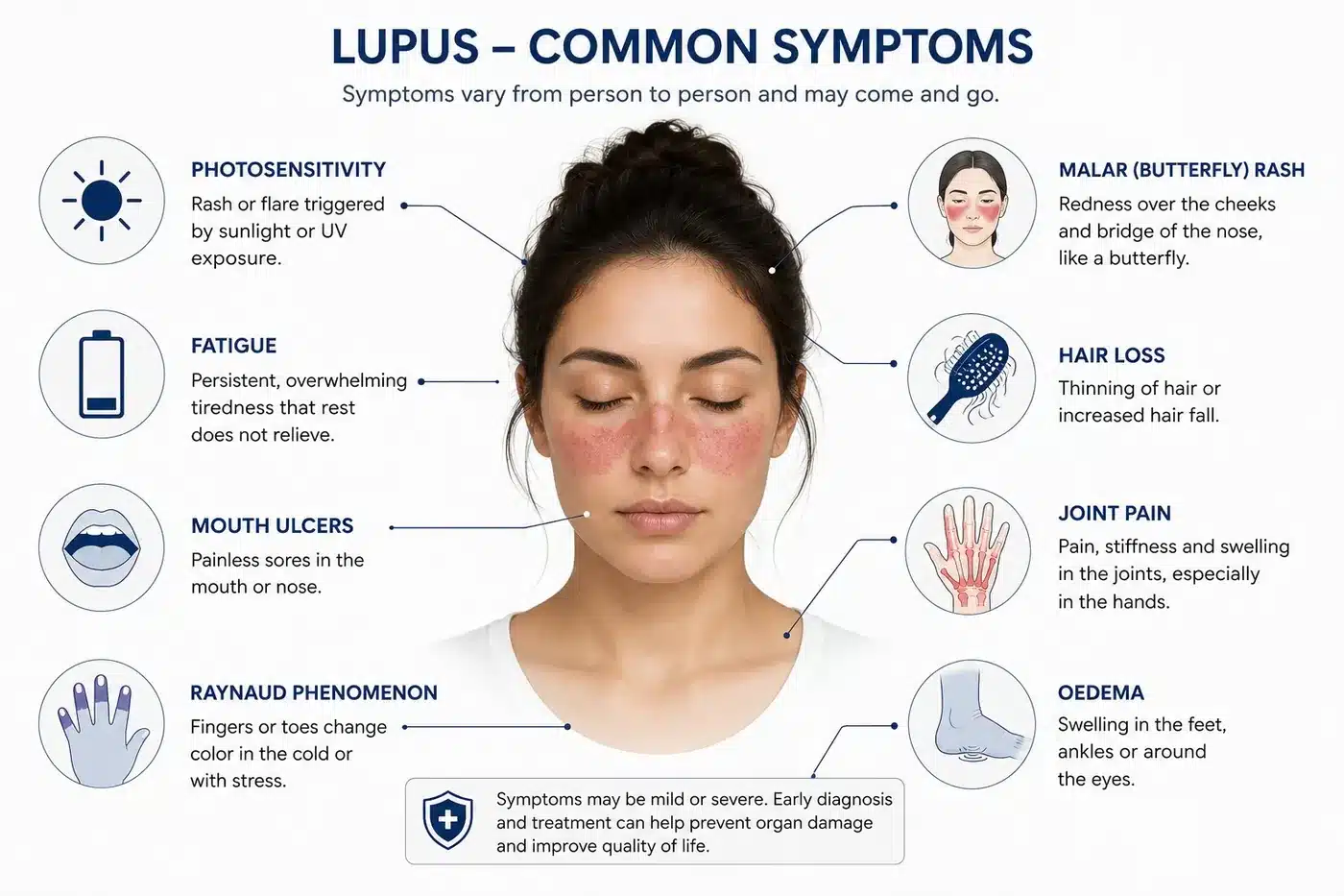 Common lupus symptoms including malar butterfly rash, joint pain, fatigue, photosensitivity, hair loss, mouth ulcers, Raynaud phenomenon and oedema