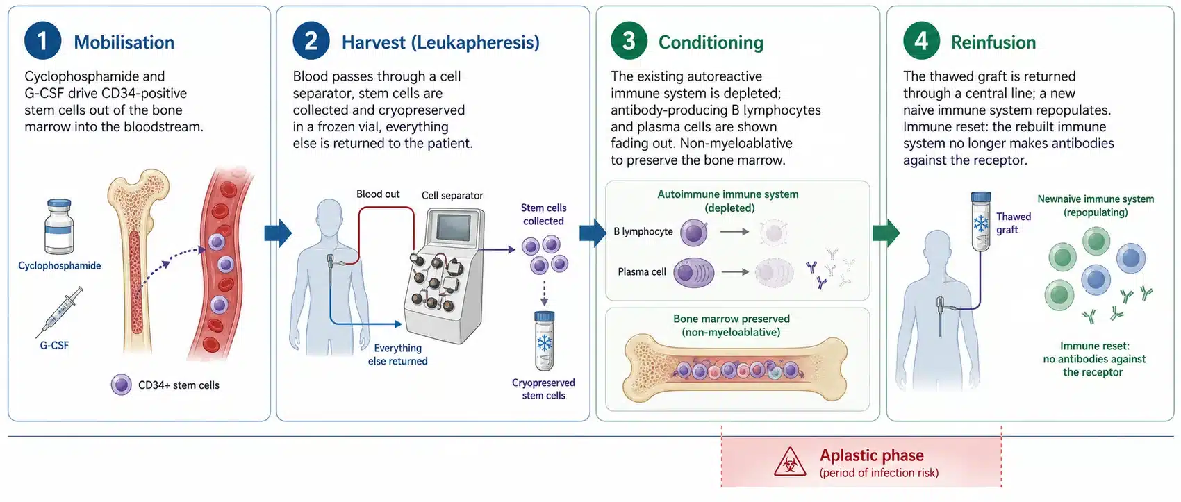 The four stages of HSCT for myasthenia gravis: mobilisation, harvest, conditioning and reinfusion, which reset the immune system that attacks the neuromuscular junction.