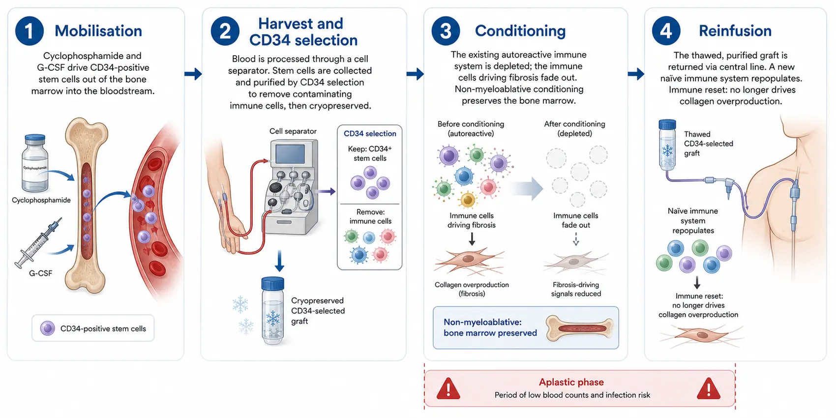 The four stages of autologous HSCT for scleroderma, including CD34 graft selection: mobilisation, harvest with CD34 selection, conditioning and reinfusion.