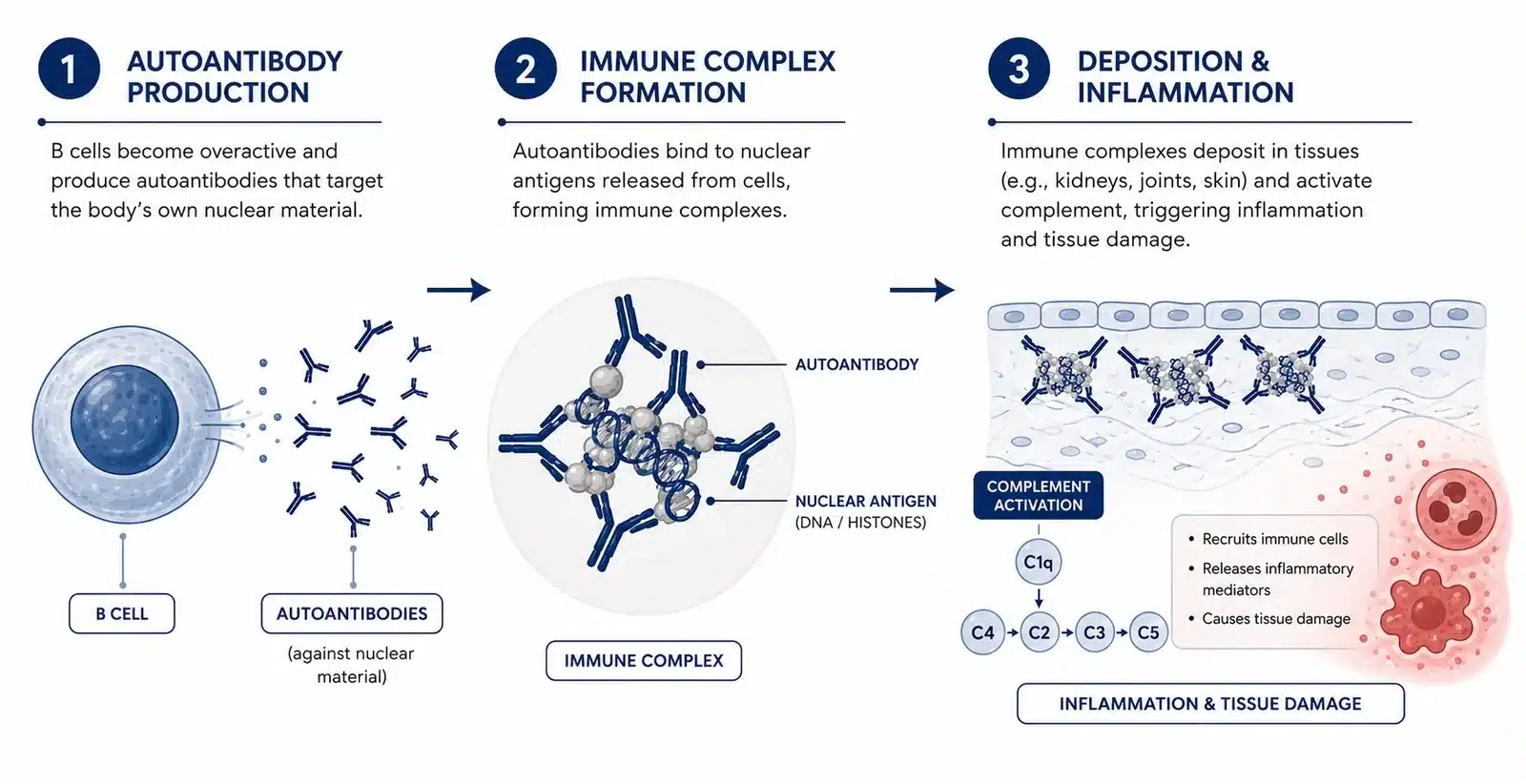 How lupus works: B cells produce autoantibodies against nuclear material, forming immune complexes that deposit in tissue and activate complement