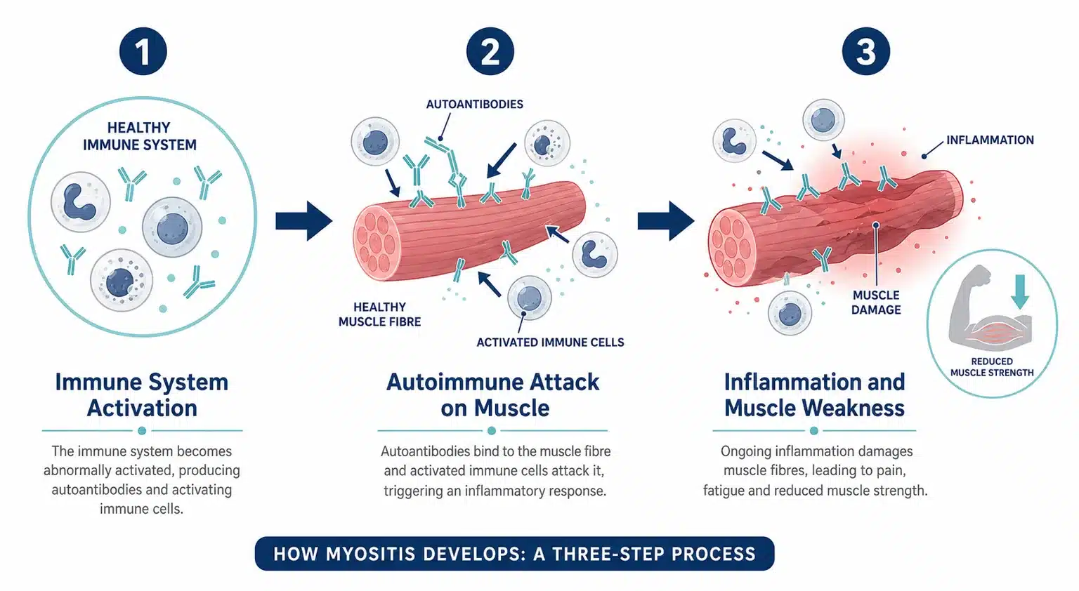 Diagram of the autoimmune attack on muscle in dermatomyositis and polymyositis