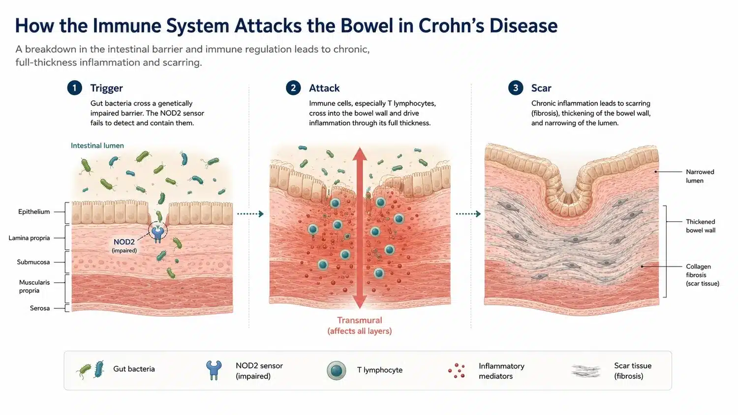 How the immune system attacks the bowel wall in Crohn's disease, and how inflammation becomes fibrosis.