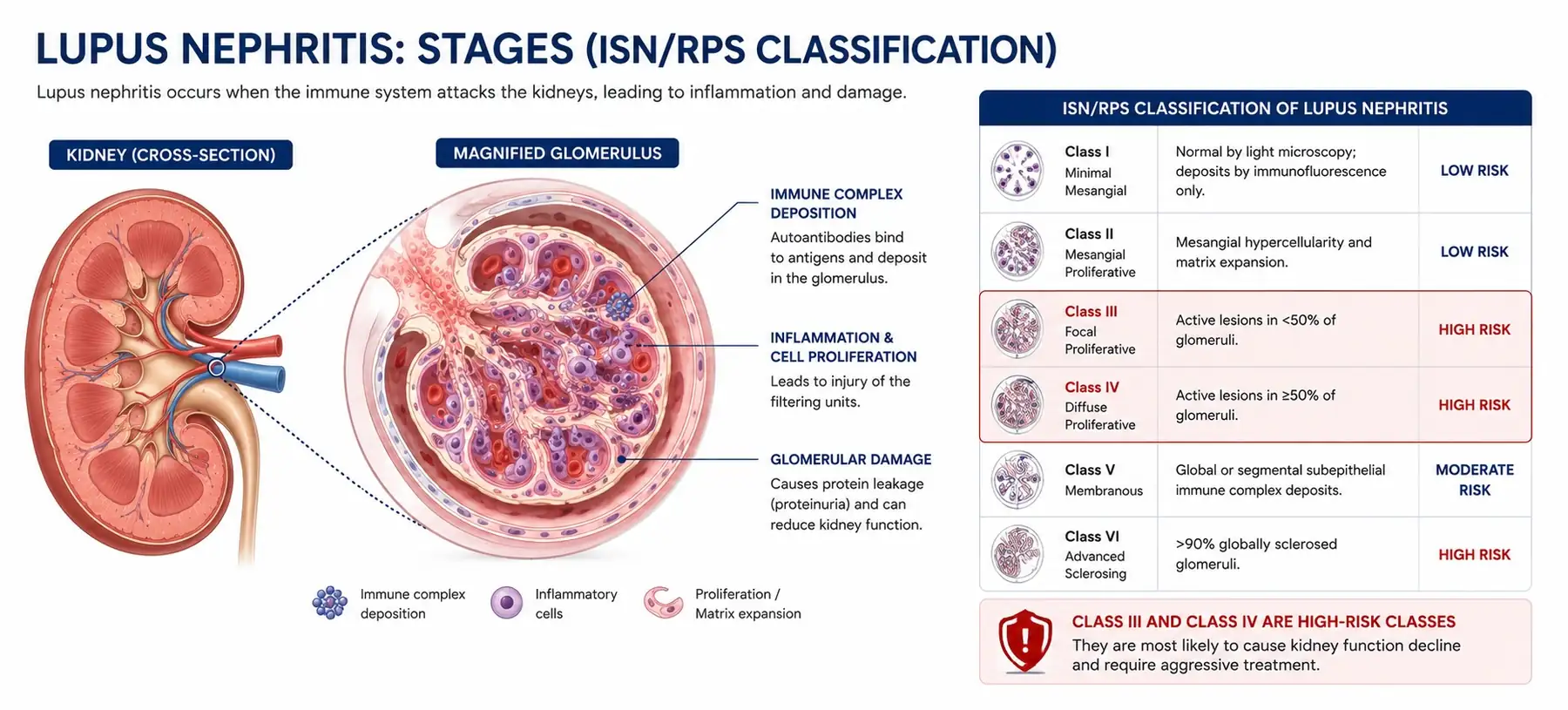 Lupus nephritis: immune complex deposition in the glomerulus and the ISN/RPS classification, with Class III and Class IV as the high-risk classes