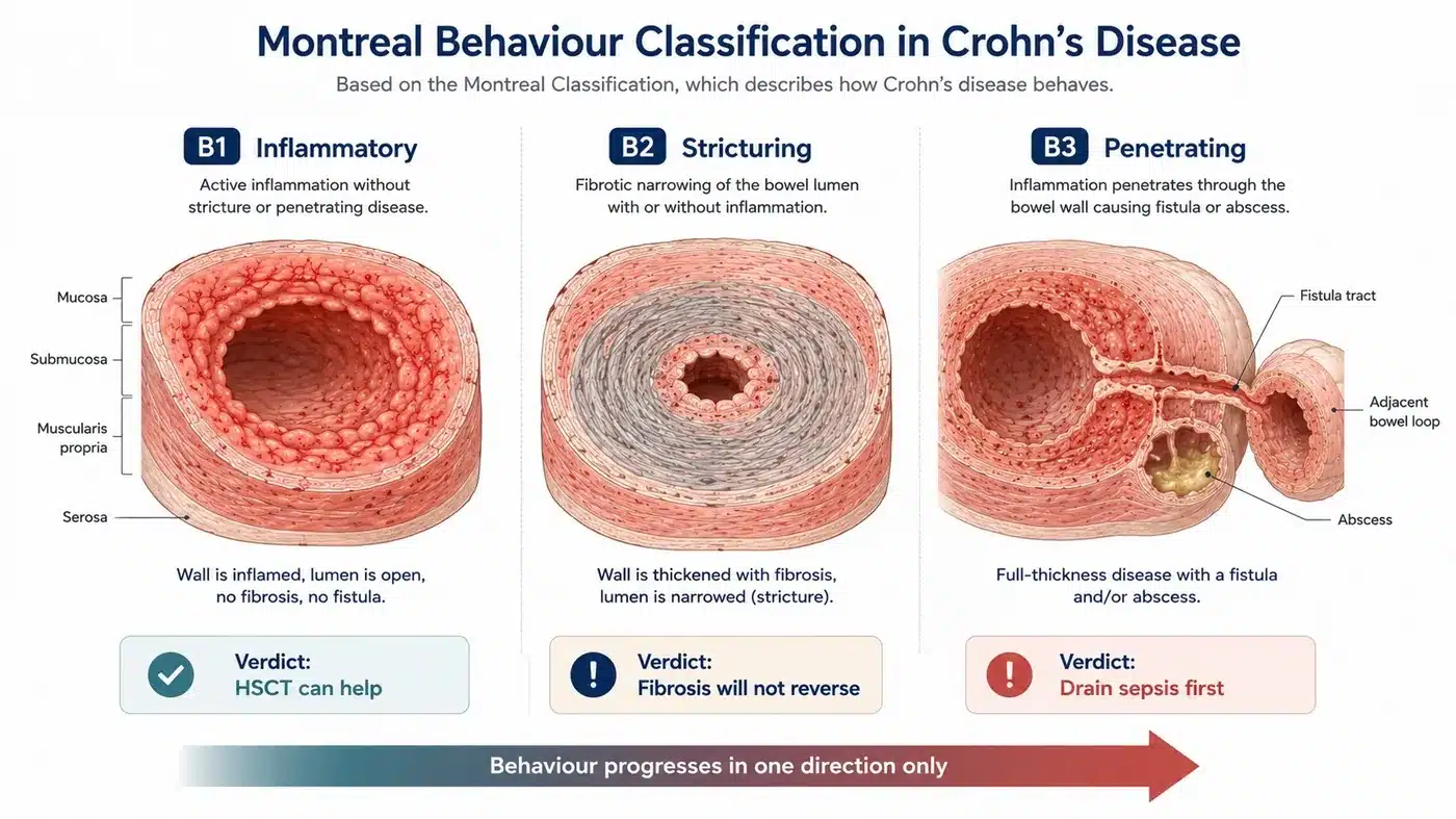 The three Montreal behaviour patterns of Crohn's disease: inflammatory, stricturing and penetrating.