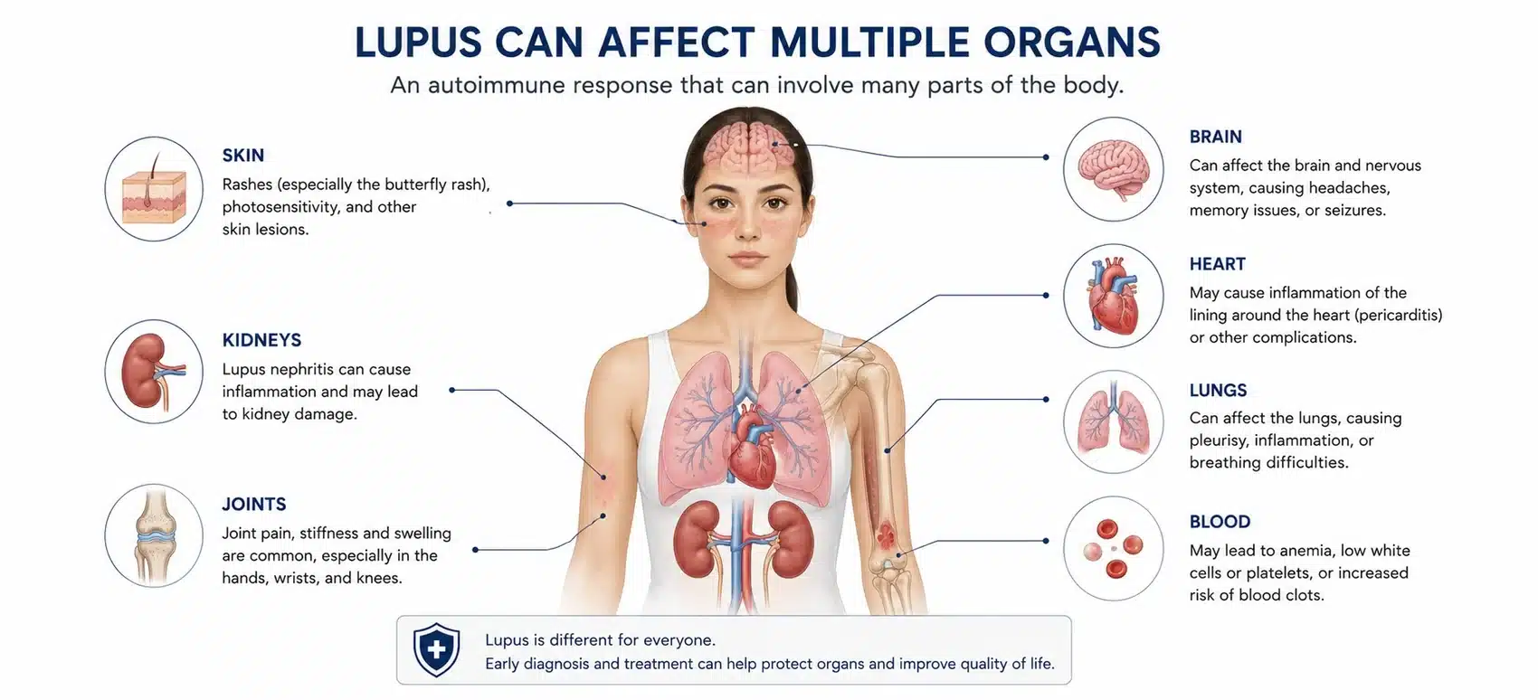 Organs affected by lupus: skin, joints, kidneys, heart, lungs, blood and brain, showing why systemic lupus erythematosus is a multi-organ disease