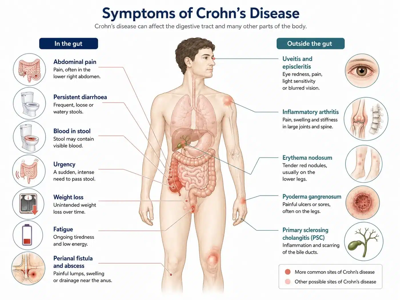 Symptoms of Crohn's disease inside the digestive tract and outside it, including joints, eyes, skin and bile ducts.
