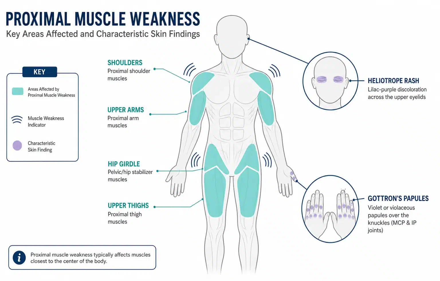 Illustration of myositis signs: weakness in the shoulders and hips, with the knuckle rash and eyelid discolouration of dermatomyositis