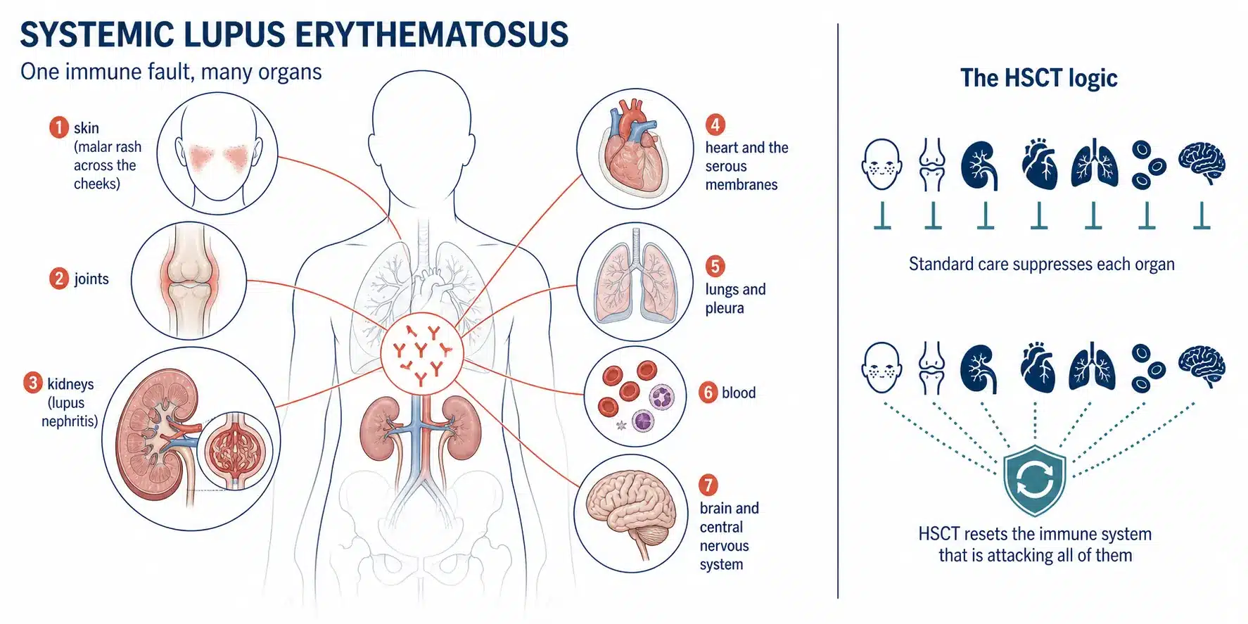 How systemic lupus erythematosus attacks the skin, joints, kidneys, heart, lungs, blood and brain from a single immune fault, and why HSCT resets the immune system rather than suppressing each organ