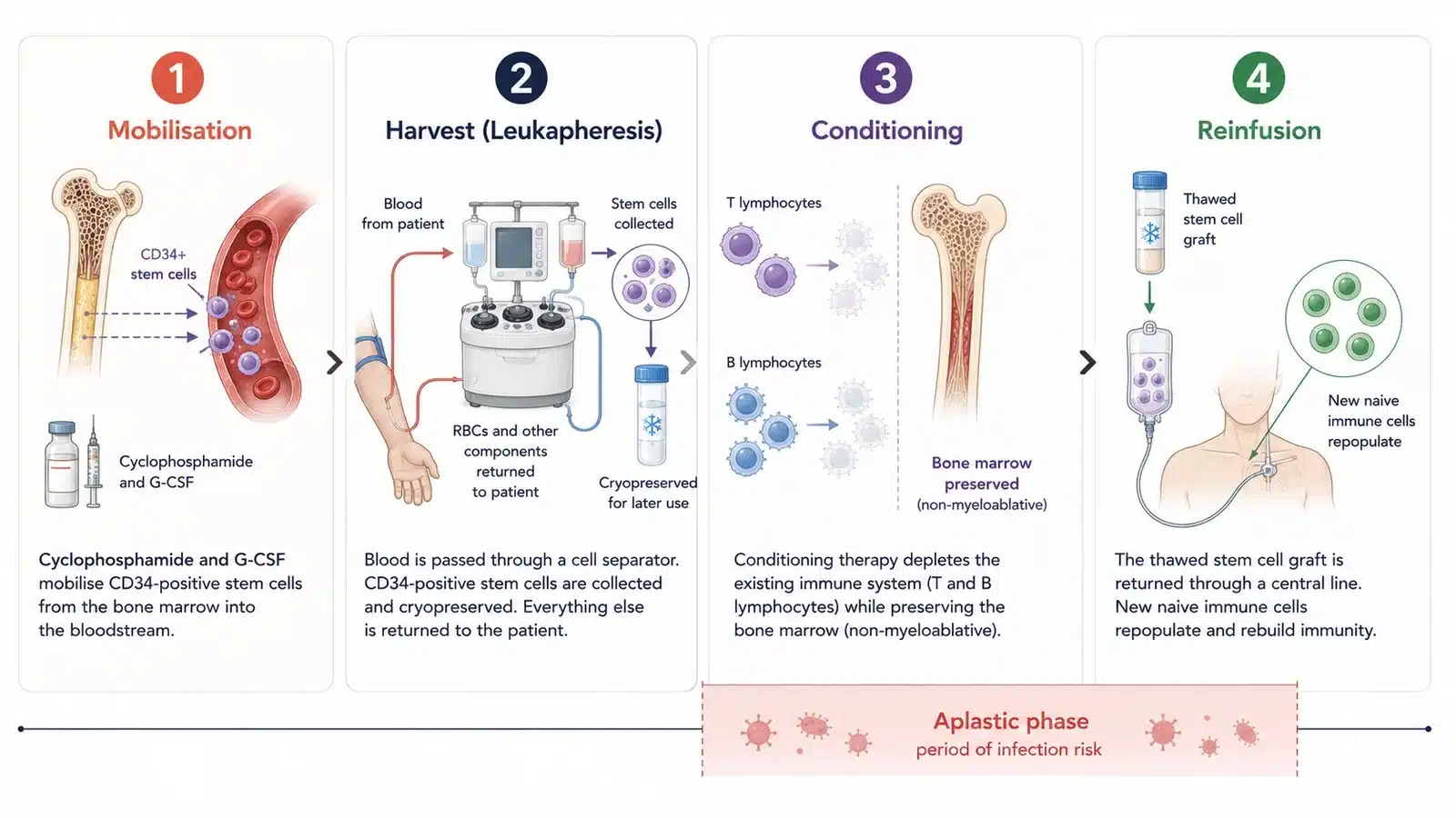 HSCT for NMOSD: the four stages of a stem cell transplant, mobilisation, harvest, conditioning and reinfusion.