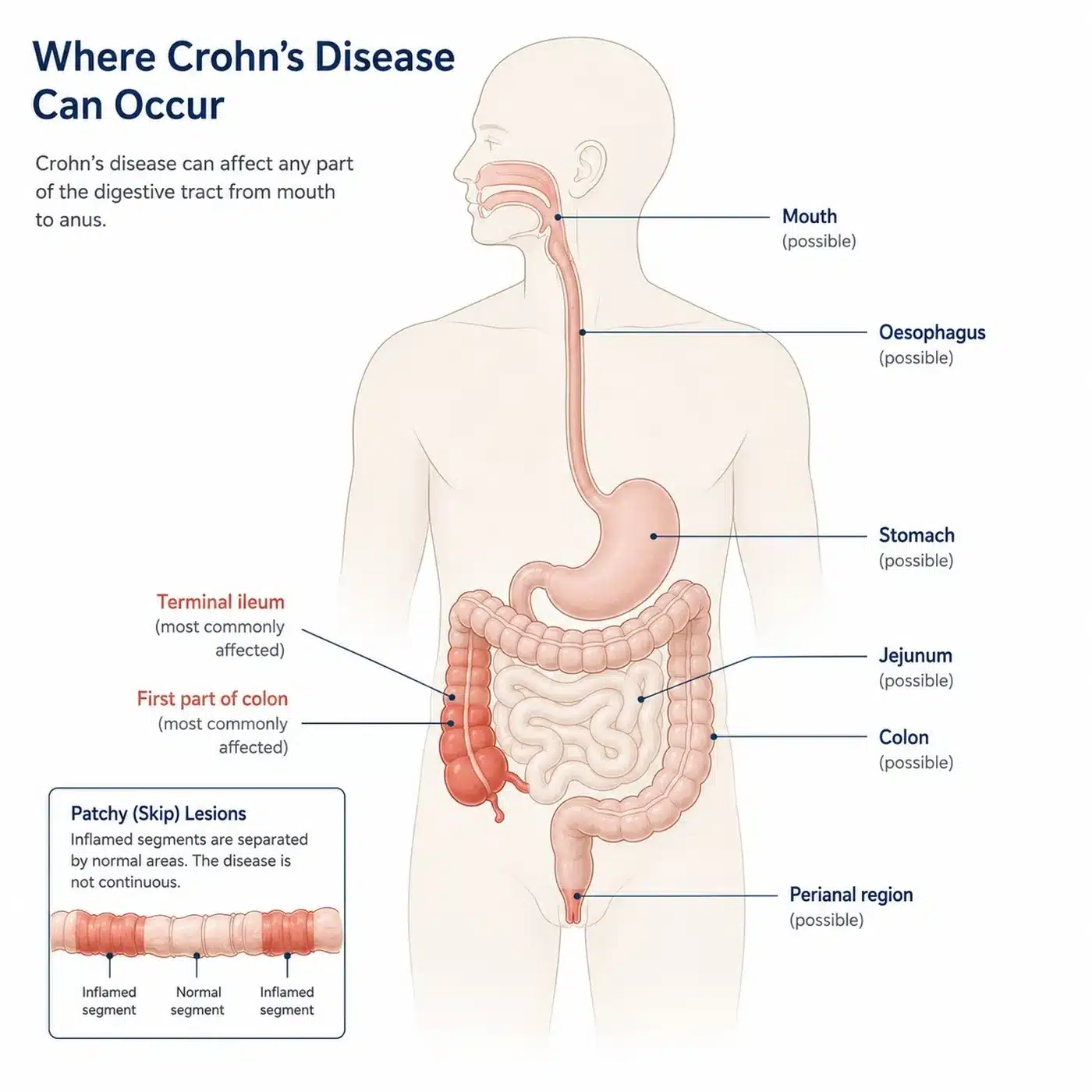 Where Crohn's disease affects the digestive tract, most commonly the terminal ileum and colon.