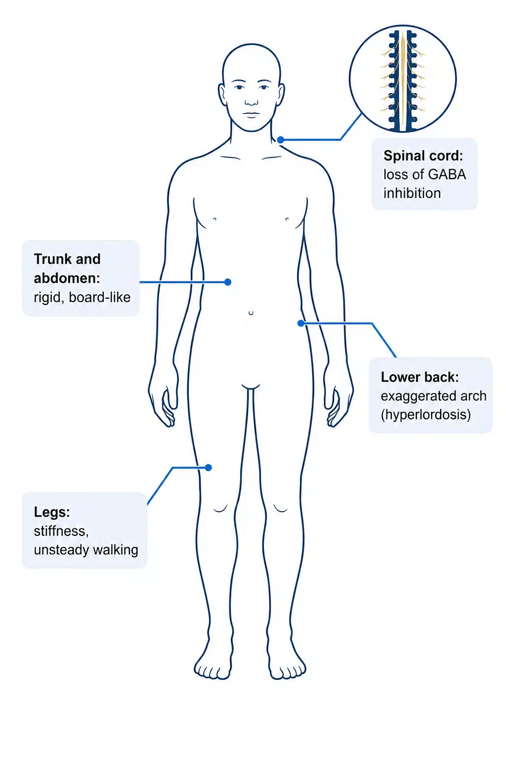 Body map of stiff person syndrome showing trunk rigidity, lumbar hyperlordosis and leg stiffness.