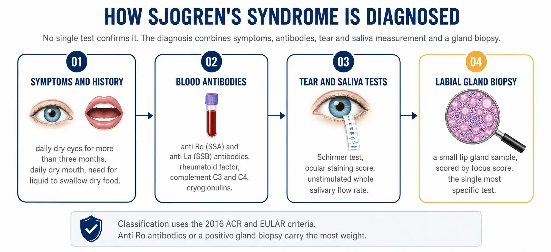 How Sjogren's syndrome is diagnosed, symptoms and history, blood antibodies, tear and saliva tests and a labial gland biopsy.