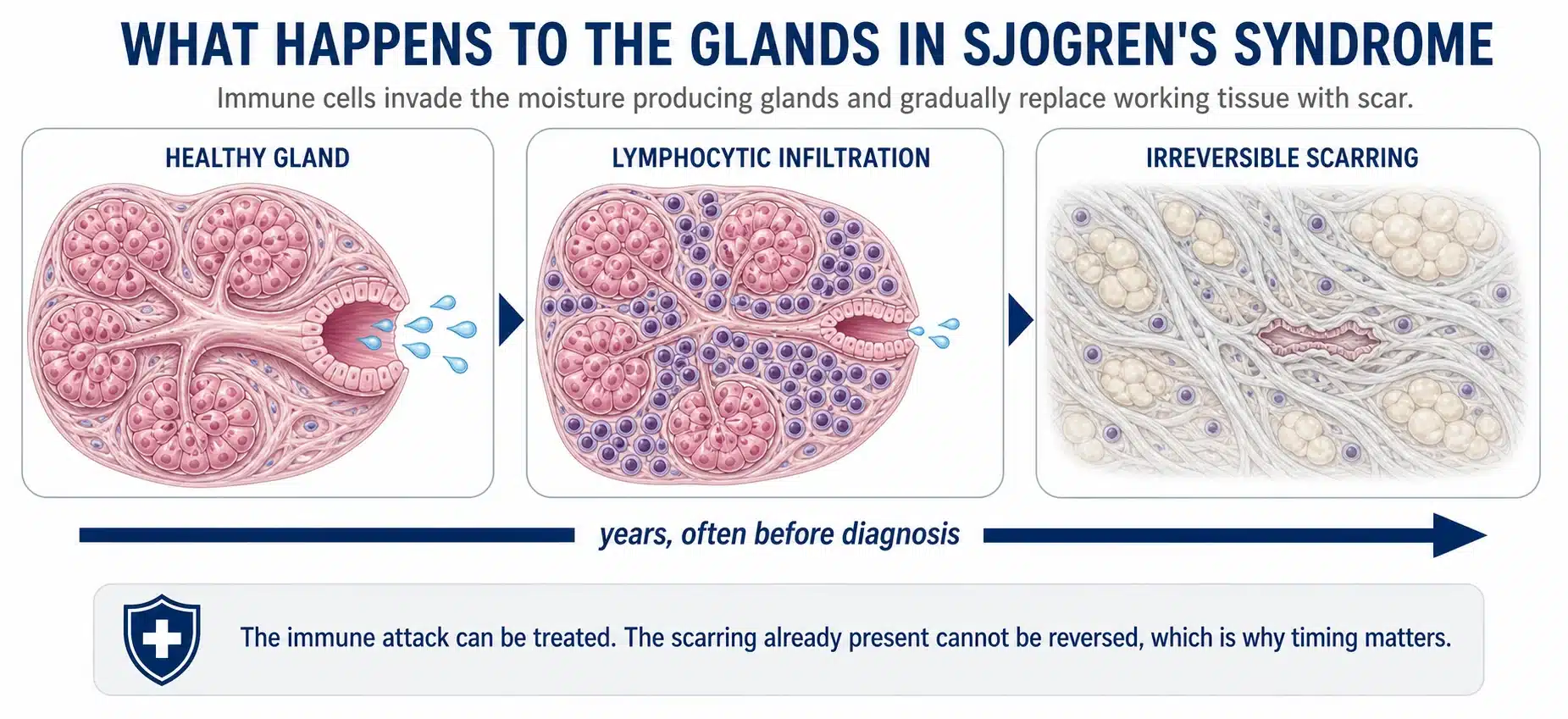 What happens to the glands in Sjogren's syndrome, from healthy gland to lymphocytic infiltration to irreversible scarring.